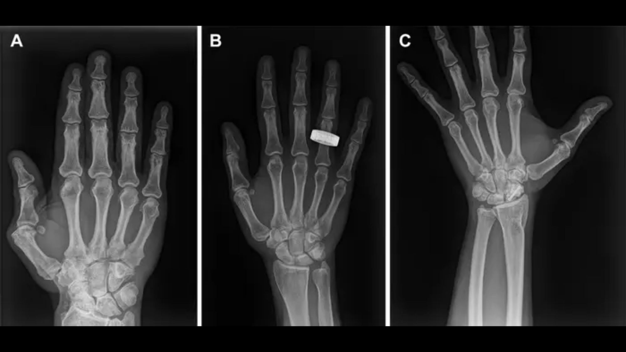Portable X-ray device tested successfully aboard Fram2 mission, proving feasibility for space medical imaging